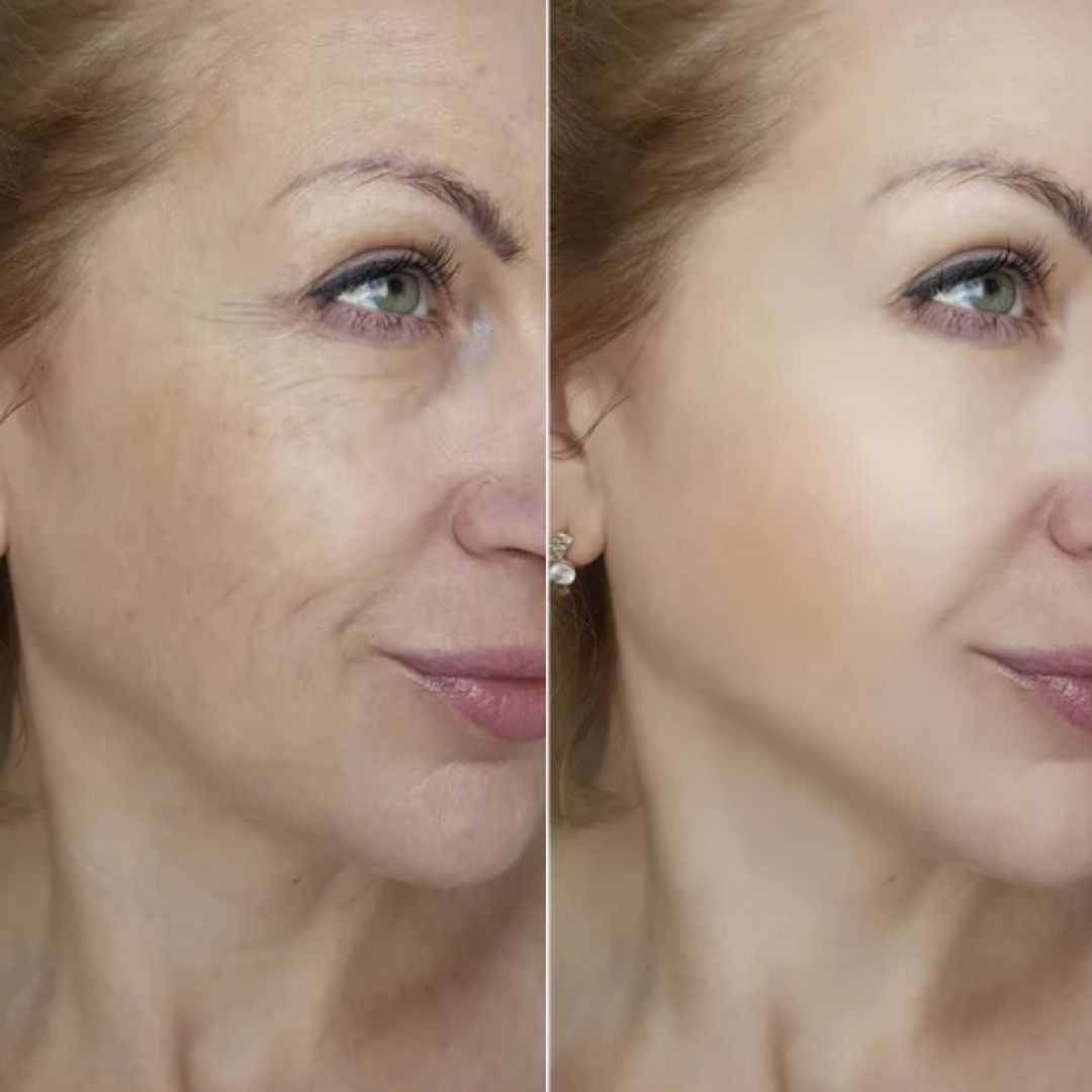 Comparativo de antes e depois do rosto de uma mulher. À esquerda, a pele apresenta rugas ao redor dos olhos, sulcos na bochecha e manchas de sol; à direita, a pele está visivelmente rejuvenescida, com tom uniforme, sem manchas e textura lisa.