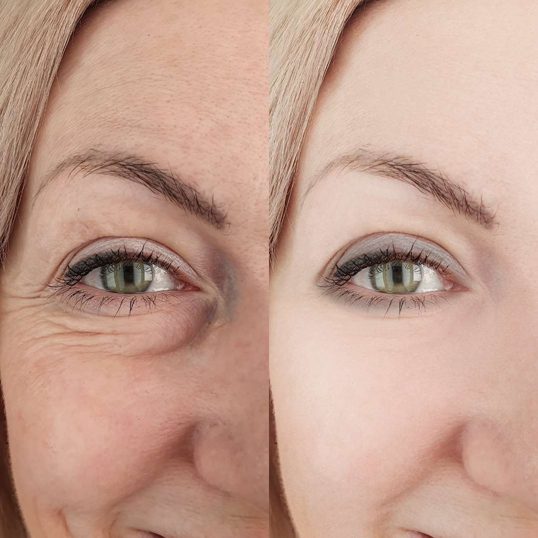 Close-up frontal do olho de uma mulher comparando antes e depois. À esquerda, presença de bolsas sob os olhos, olheiras profundas e rugas finas; à direita, a região está iluminada, sem bolsas e com a pele completamente lisa.