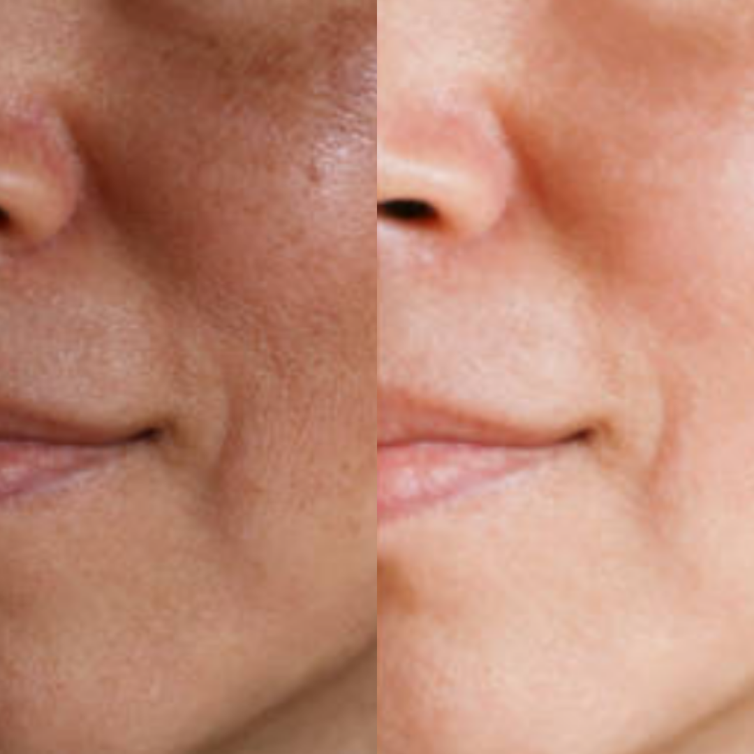 Comparação de antes e depois do tratamento facial, mostrando à esquerda uma pele com manchas de melasma e rugas finas, e à direita uma pele visivelmente mais clara, uniforme e rejuvenescida.