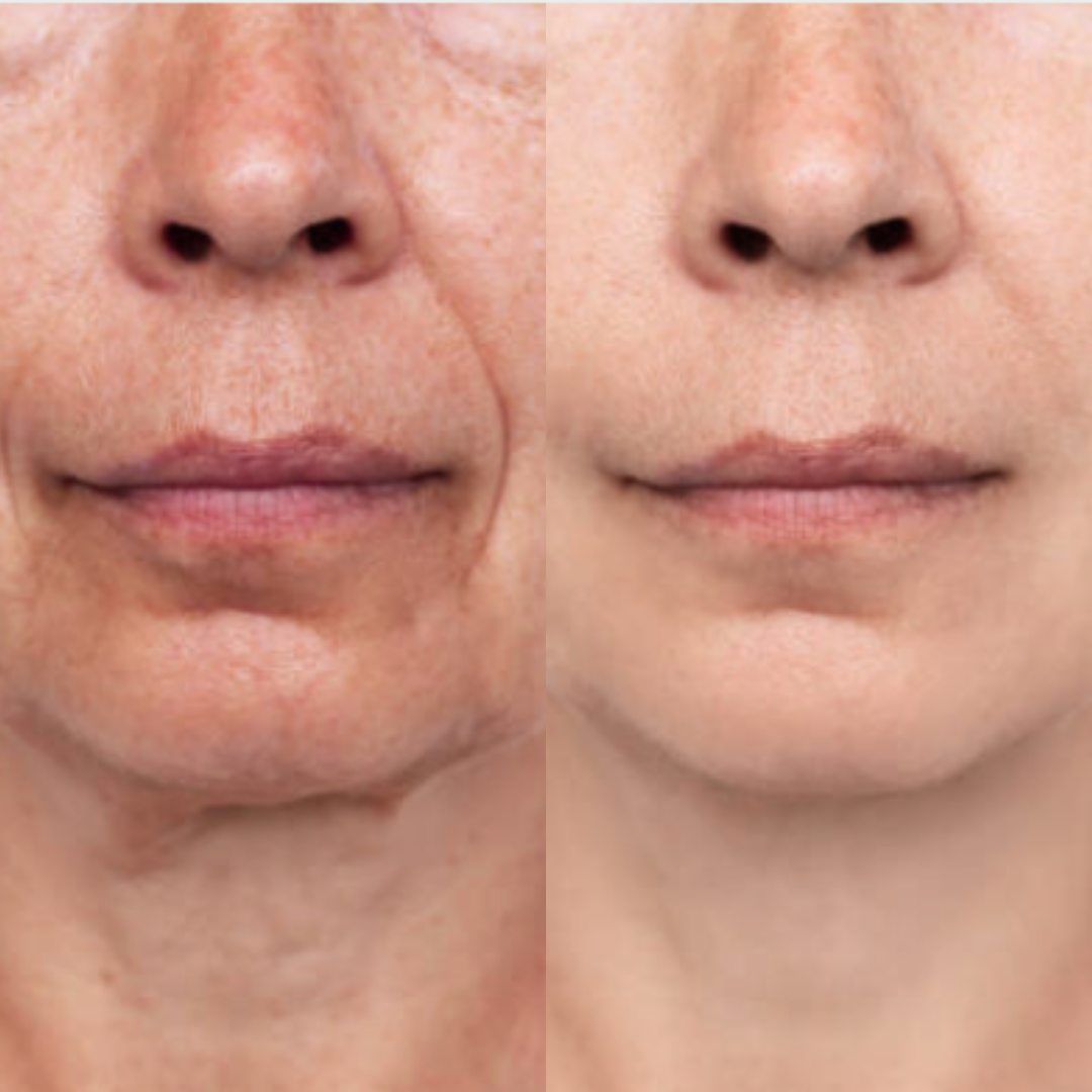 Foto de close lateral do rosto de uma pessoa mostrando o antes e depois de um tratamento de pele. À esquerda, os poros estão dilatados e há pequenas manchas; à direita, a textura da pele está visivelmente mais lisa, com poros reduzidos e tom mais uniforme.