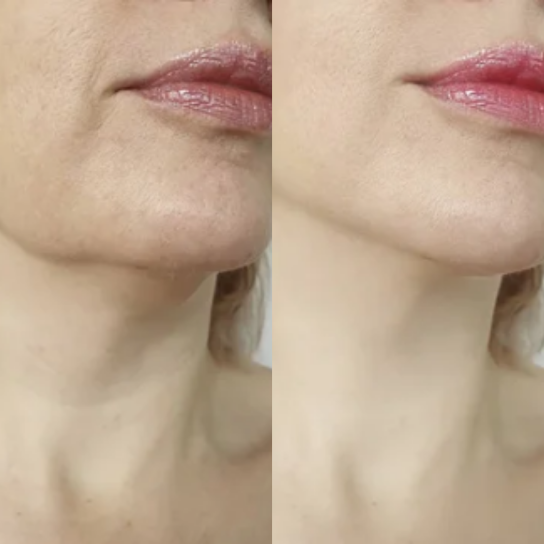 Imagem de antes e depois focada no clareamento de hiperpigmentação e melasma. O comparativo demonstra a eficácia do tratamento com rosa amazonica para clarear e uniformizar a pele e redução de sardas e manchas senis.