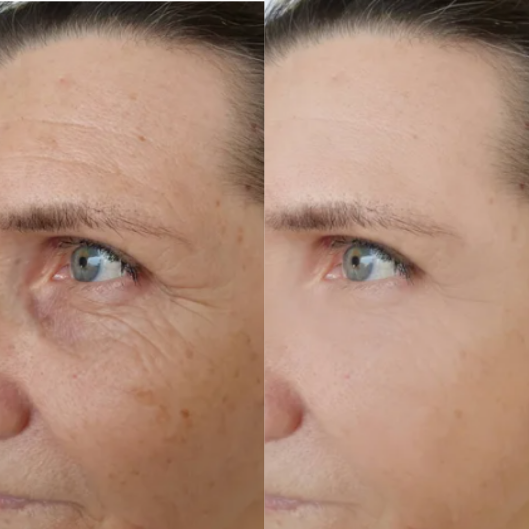 Close lateral do rosto de uma pessoa mostrando o antes e depois de um tratamento para manchas e textura da pele. A imagem da direita apresenta sardas e manchas de sol mais suaves e poros menos aparentes em comparação à imagem da esquerda.